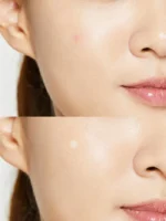 Acne Pimple Master Patch - Image 4